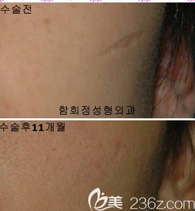 韩国dr.ham's疤痕医院案例