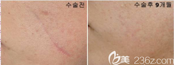 韩国dr.ham's疤痕医院案例