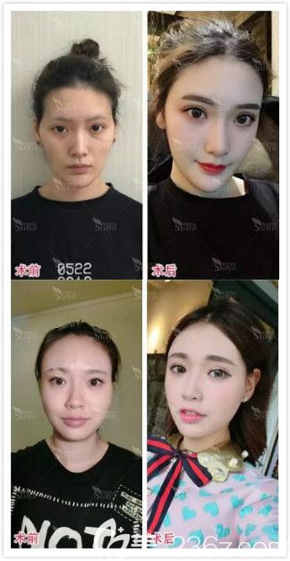 长沙星雅整形自体脂肪填充面部真人前后效果对比图 长沙星雅整形自体脂肪填充面部真人前后效果对比图