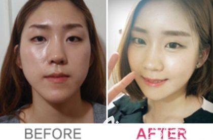 <!--<i data=20240703-sp></li>
<li><i data=20240703-sp></i>-->双鄂+额头假体填充<span style=