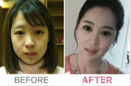 <!--<i data=20240703-sp></li>
<li><i data=20240703-sp></i>-->颜面轮廓+眼型矫正+开内眼角+鼻部整形+脂肪移植<span style=