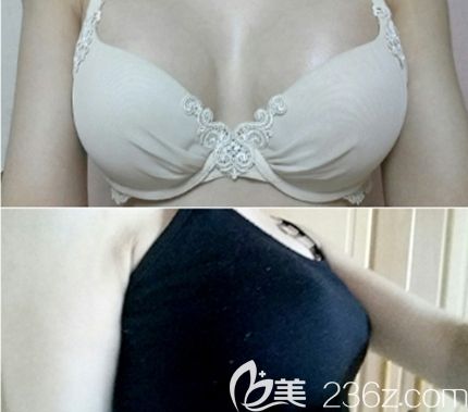 在韩国TL整形医院做隆胸手术后1个月
