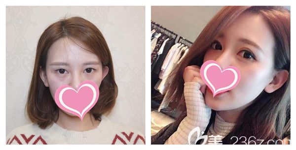 孝感天妃<!--<i data=20240703-sp></i>-->博士切开双眼皮+开眼角打造芭比电眼术后对比图 孝感天妃<!--<i data=20240703-sp></i>-->博士切开双眼皮+开眼角打造芭比电眼术后对比图