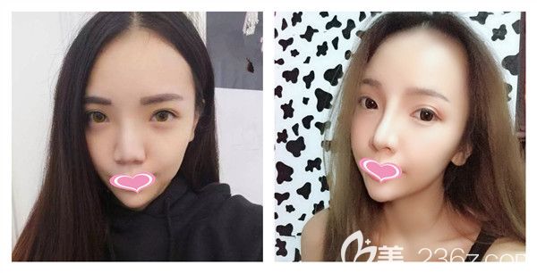 孝感天妃<!--<i data=20240703-sp></i>-->达拉斯综合假体隆鼻手术前后对比图片展示 孝感天妃<!--<i data=20240703-sp></i>-->达拉斯综合假体隆鼻手术前后对比图片展示