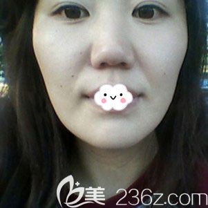 韩国菲斯莱茵Faceline整形李泰喜自体脂肪面部填充+颧骨缩小真人案例 韩国菲斯莱茵Faceline整形李泰喜自体脂肪面部填充+颧骨缩小真人案例