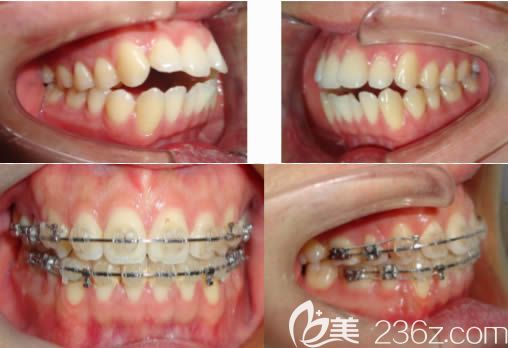 莫媛媛医生牙齿开合矫正案例效果图 莫媛媛医生牙齿开合矫正案例效果图