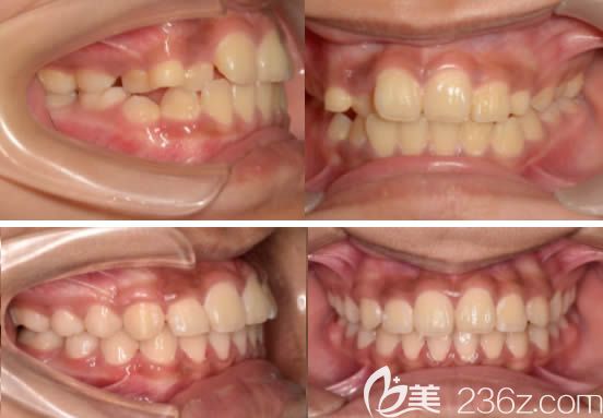 莫媛媛青少年牙齿拥挤矫正前后对比效果 莫媛媛青少年牙齿拥挤矫正前后对比效果