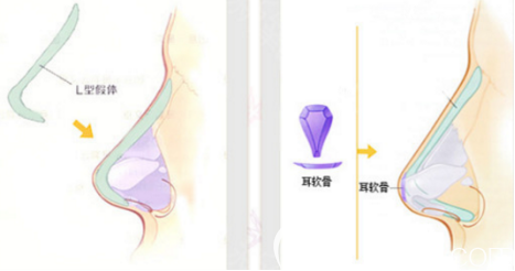 耳软骨隆鼻示意图
