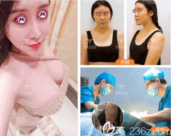 北京润美玉之光王明利医生CGF+JET自体脂肪丰胸案例 北京润美玉之光王明利医生CGF+JET自体脂肪丰胸案例