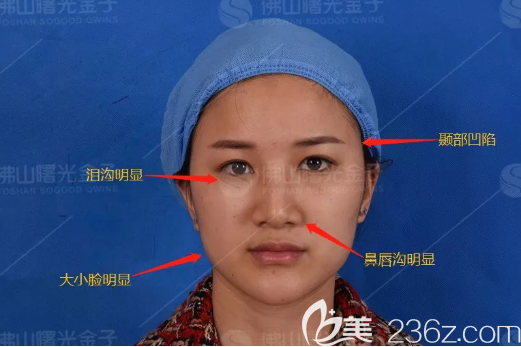 在佛山曙光金子做线雕术前照片 在佛山曙光金子做线雕术前照片