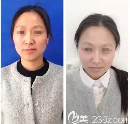 到淮安华美做前后对比案例 到淮安华美做前后对比案例