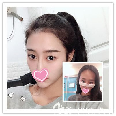 激光祛眼袋+自体脂肪丰卧蚕术后1-10天图片