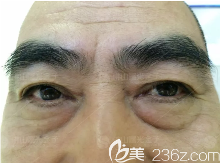 在佛山曙光金子做祛眼袋术前照片 在佛山曙光金子做祛眼袋术前照片