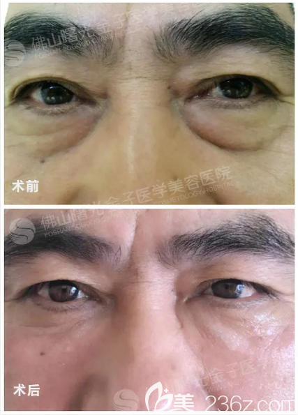 佛山曙光金子甘国端院长祛眼袋价格6800元 佛山曙光金子甘国端院长祛眼袋价格6800元