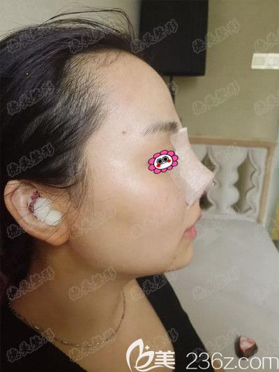 刚做完手术后的样子 刚做完手术后的样子