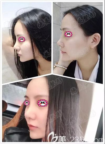 鼻综合术后第七天拆线后的照片 鼻综合术后第七天拆线后的照片