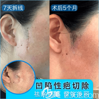 北京亚馨美莱坞张海明医生凹陷性疤痕切除案例
