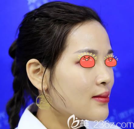 义乌阳光医院做肋骨鼻手术前 义乌阳光医院做肋骨鼻手术前