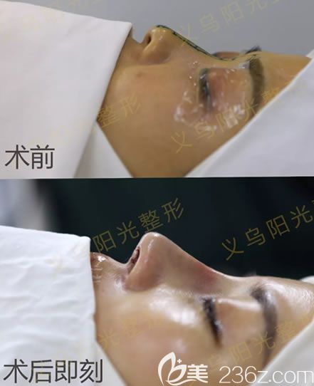 义乌阳光整形医院肋骨鼻即刻<span style= 义乌阳光整形医院肋骨鼻即刻<span style=