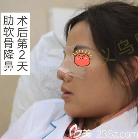 义乌阳光肋骨鼻<span style= 义乌阳光肋骨鼻<span style=