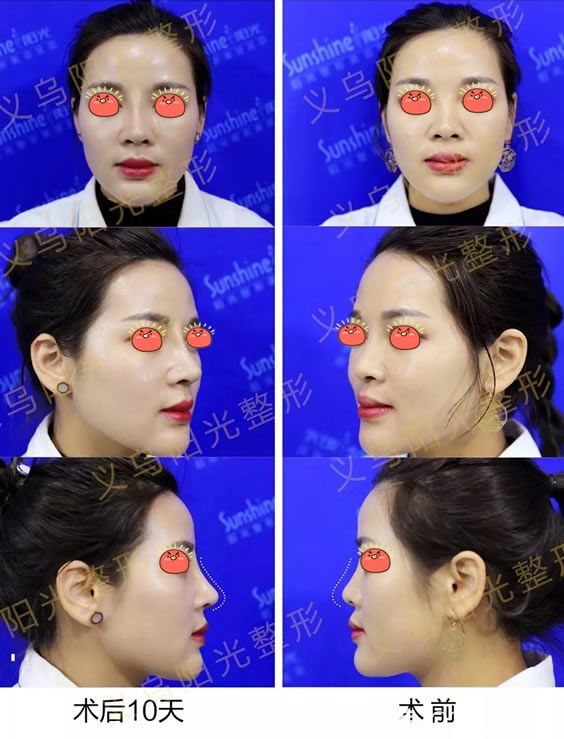 义乌阳光肋软骨鼻综合<span style= 义乌阳光肋软骨鼻综合<span style=