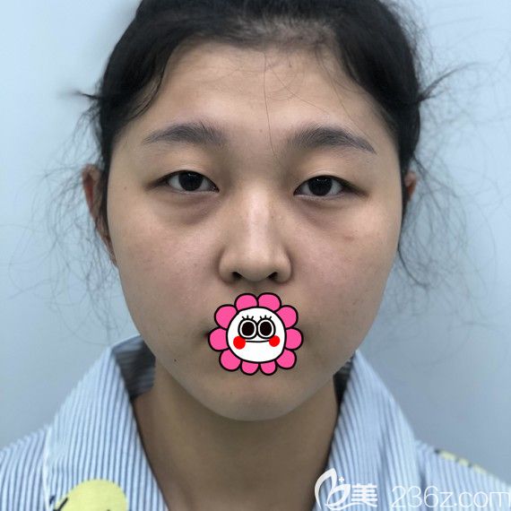 没做双眼皮前的我 没做双眼皮前的我