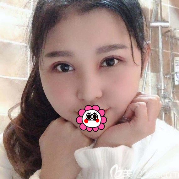 哈尔滨索菲吕松岸双眼皮恢复一个月效果 哈尔滨索菲吕松岸双眼皮恢复一个月效果