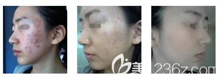 张培红医生激光祛痘案例 张培红医生激光祛痘案例