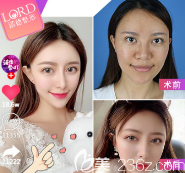 青岛自体脂肪填充面部案例一