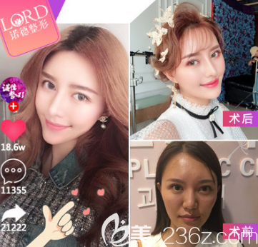 青岛自体脂肪填充改善凸嘴案例二