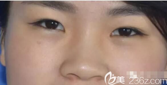 面诊淮安华美术前塌鼻子 面诊淮安华美术前塌鼻子