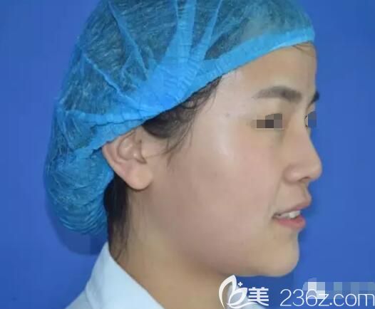 刚做完艾莉薇玻尿酸注射隆鼻效果 刚做完艾莉薇玻尿酸注射隆鼻效果