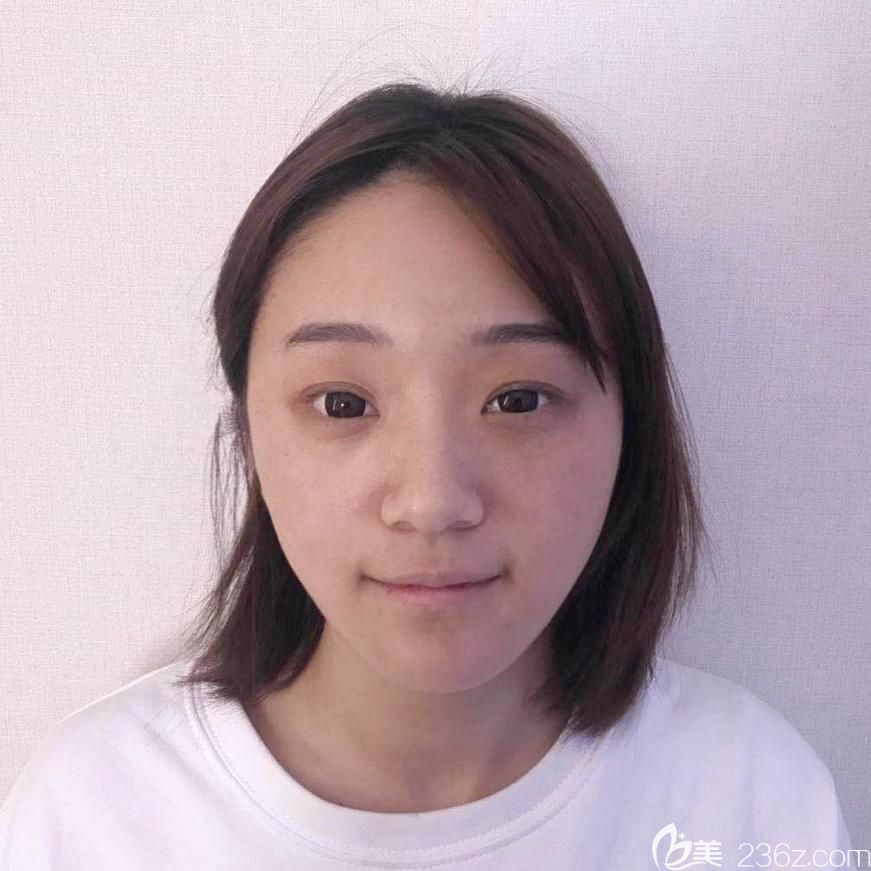 埋线双眼皮失败后照片 埋线双眼皮失败后照片