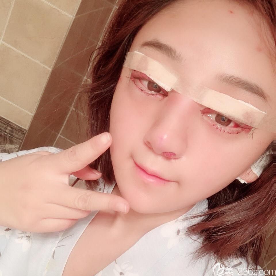 合肥白领安琪儿眼综合+鼻综合术后当天 合肥白领安琪儿眼综合+鼻综合术后当天