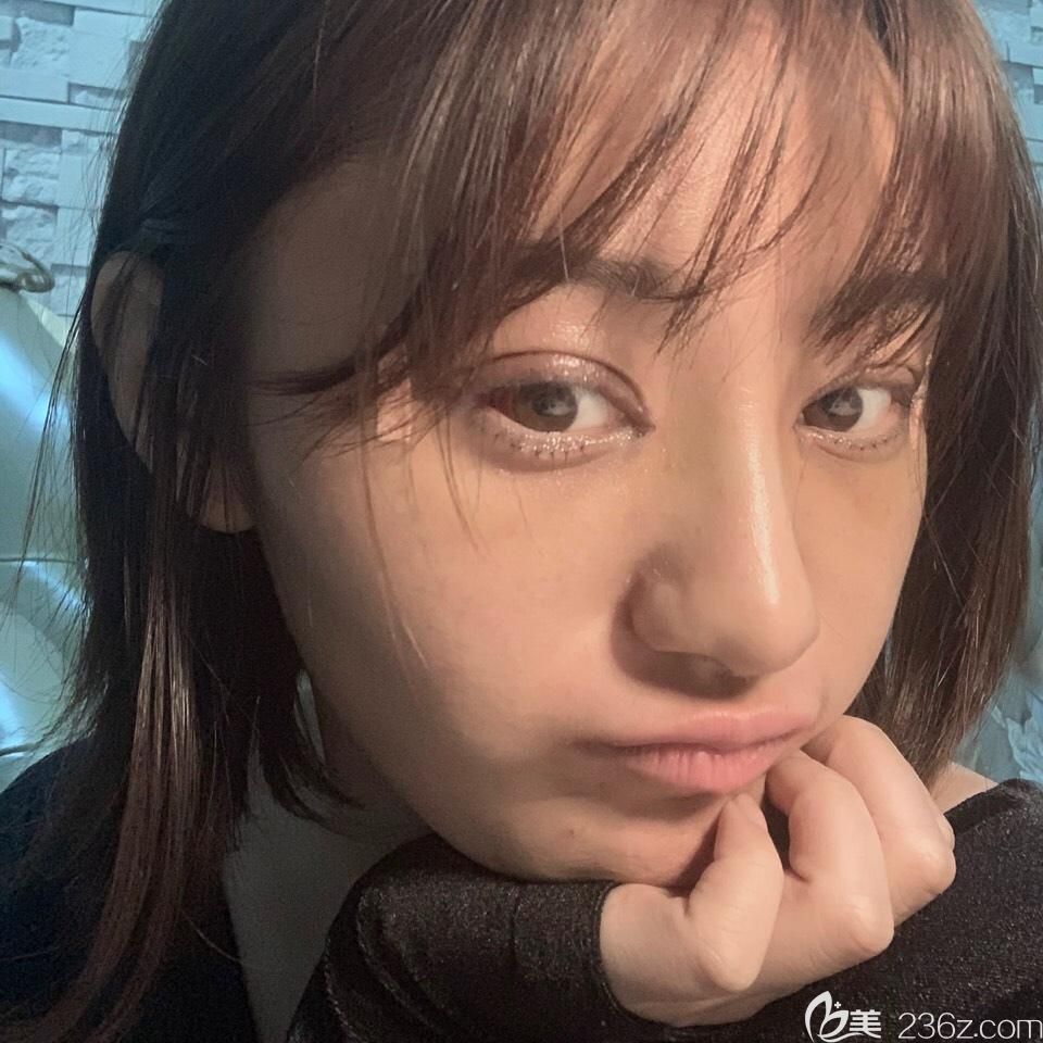 找胡准做双眼皮失败修复+鼻综合第4天 找胡准做双眼皮失败修复+鼻综合第4天