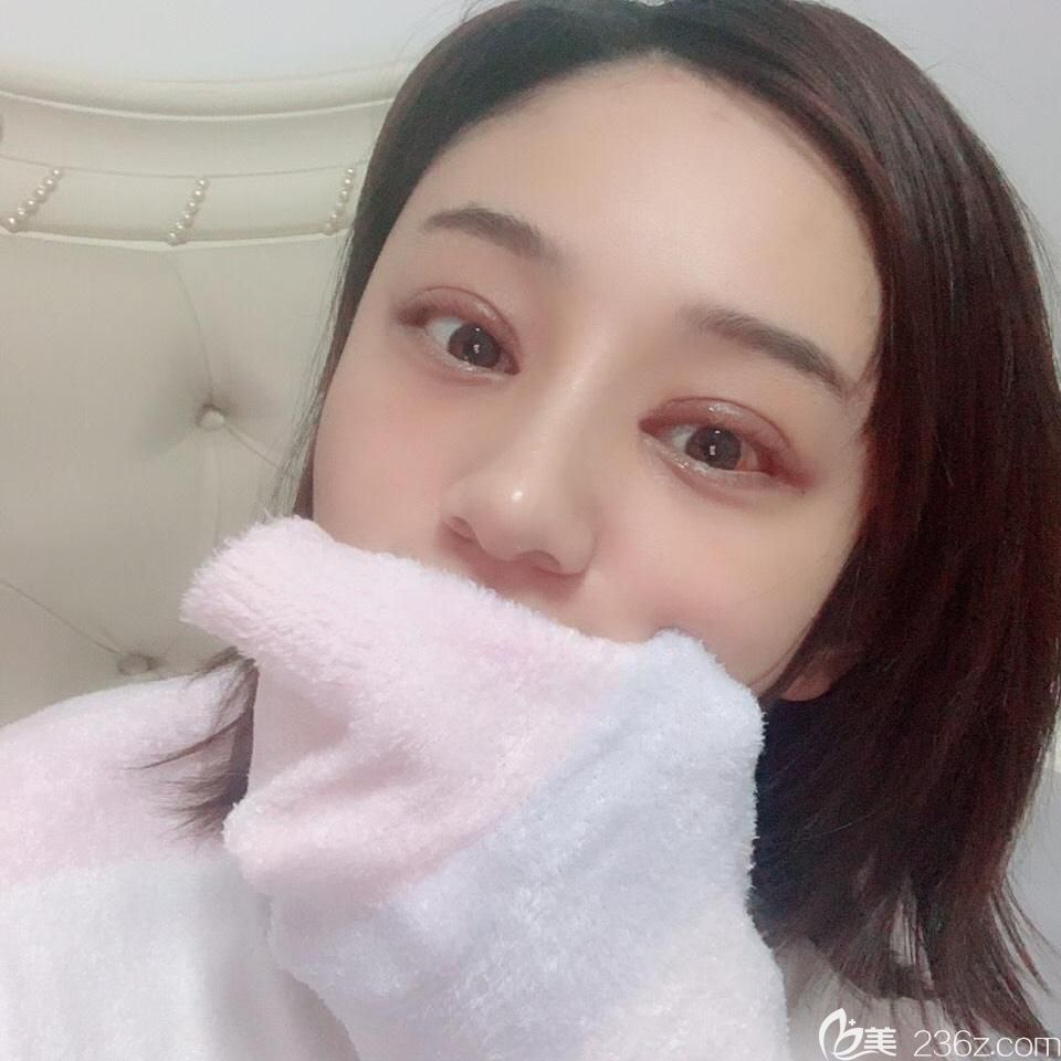 合肥白领安琪儿双眼皮修复+鼻综合术后第7天拆线后照片 合肥白领安琪儿双眼皮修复+鼻综合术后第7天拆线后照片