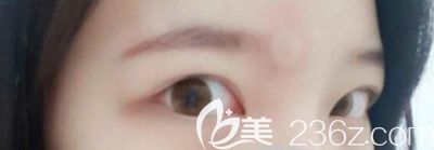 在韩国本爱做眼综合手术前 在韩国本爱做眼综合手术前