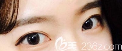 妹子天生内双 找韩国本爱医院的文圣昊院长做了眼综合手术后就改善了这个问题