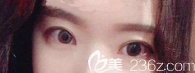 在韩国本爱做眼综合手术1个月 在韩国本爱做眼综合手术1个月