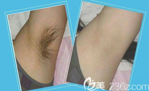 华美整形医院激光脱毛案例 华美整形医院激光脱毛案例