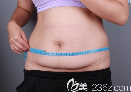 我在南宁韩星整形做腰腹部环形吸脂前的照片 我在南宁韩星整形做腰腹部环形吸脂前的照片