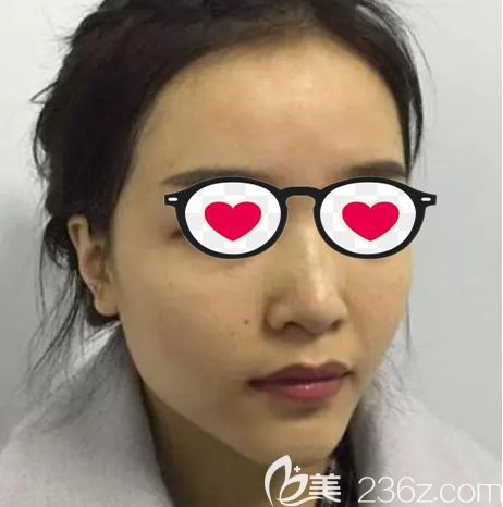 呼和浩特京美整形医院朱京成院长鼻综合隆鼻前 呼和浩特京美整形医院朱京成院长鼻综合隆鼻前