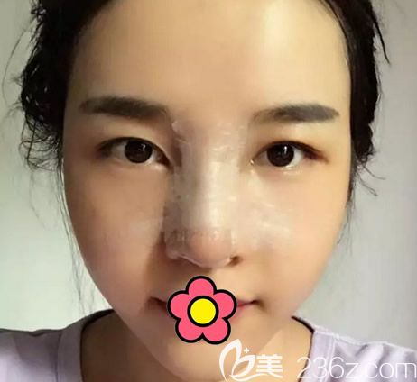 京美整形朱京成自体软骨隆鼻第五天效果 京美整形朱京成自体软骨隆鼻第五天效果