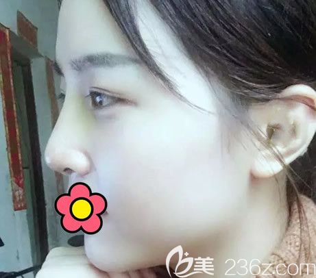 呼和浩特京美鼻综合手术第七天拆线后图片 呼和浩特京美鼻综合手术第七天拆线后图片