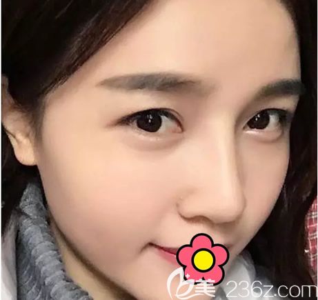 呼市京美假体隆鼻+自体软骨隆鼻一个月的恢复效果怎么样 呼市京美假体隆鼻+自体软骨隆鼻一个月的恢复效果怎么样