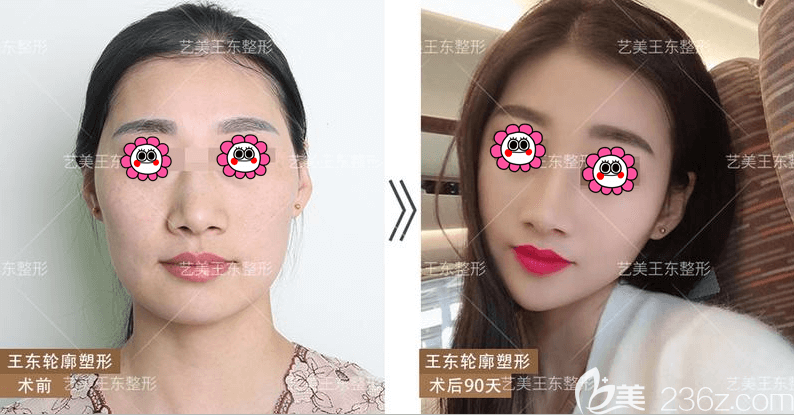 北京艺美王东医生不开刀缩下颌角案例 北京艺美王东医生不开刀缩下颌角案例
