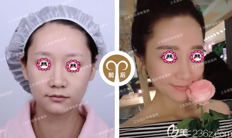 北京艺美王东医生面部脂肪填充案例 北京艺美王东医生面部脂肪填充案例