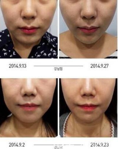 韩国美尔韩面部埋线提升案例 韩国美尔韩面部埋线提升案例