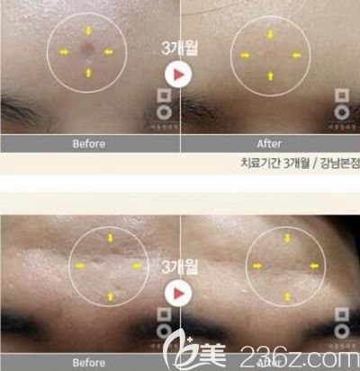韩国美尔韩美肤治疗案例 韩国美尔韩美肤治疗案例