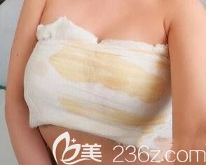 我在南宁东方整形做自体脂肪隆胸术后当天 我在南宁东方整形做自体脂肪隆胸术后当天